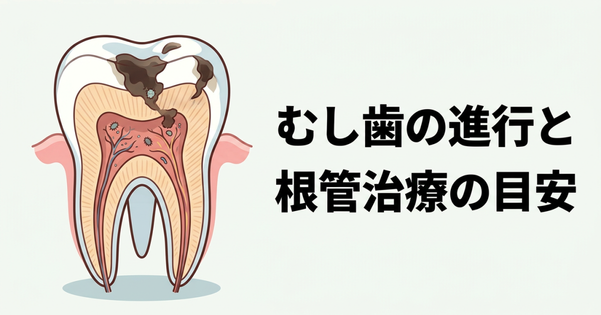 むし歯はどこまで進行すると神経の治療が必要？　根管治療の目安について