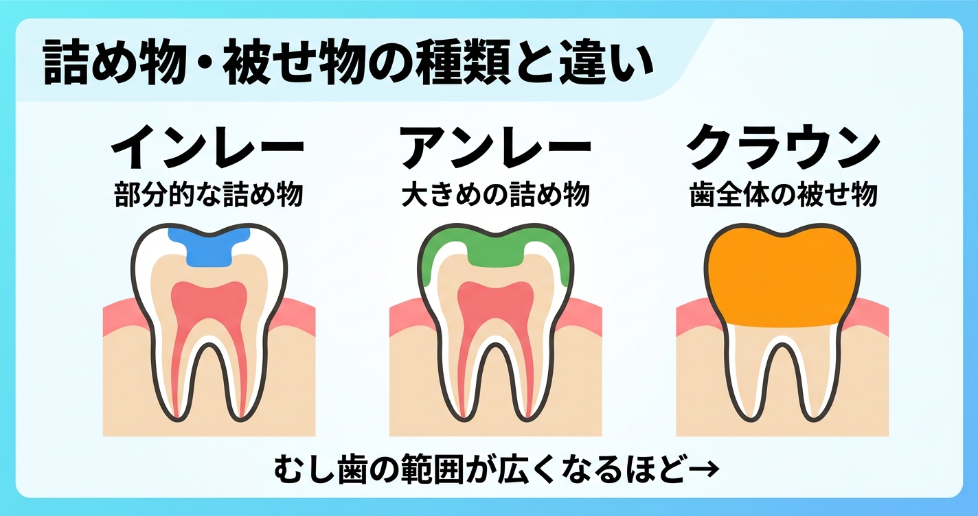 インレー・アンレー・クラウンの違いとは？　歯医者で使われる詰め物・被せ物の種類